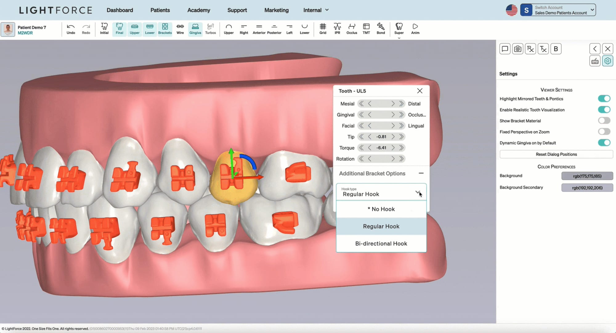 LightForce 3D Printed Ceramic Braces Cumming, Teeth Straightening