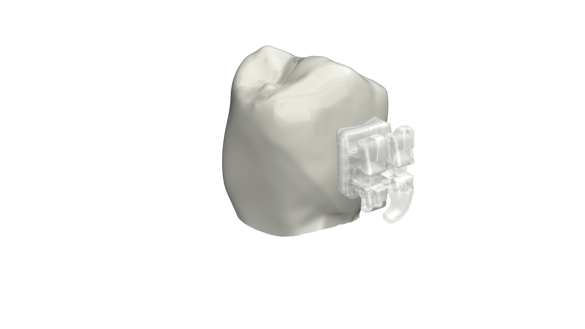 Tooth and clear bracket 2
